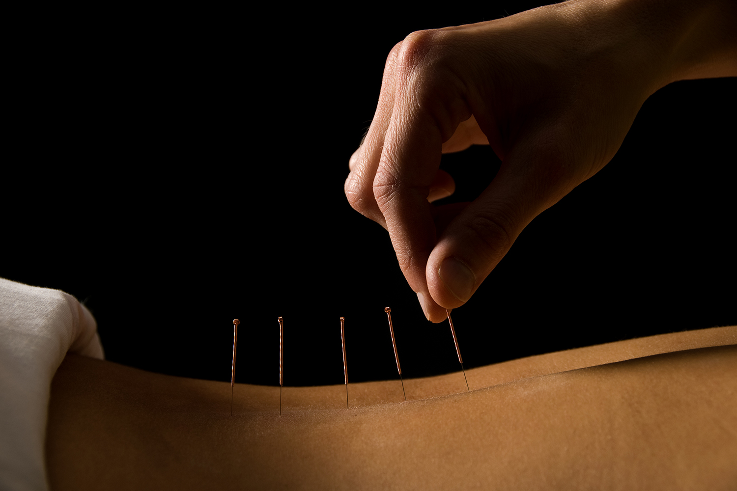 someone receiving acupuncture on their back in a dark room