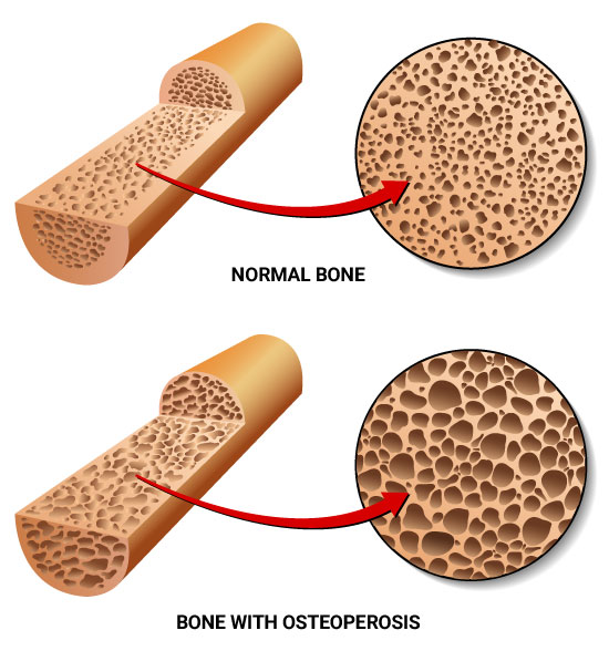 osteoporosis diagram