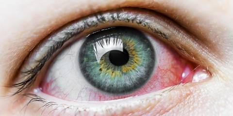 a beautiful eye marred by redness from conjunctivitis
