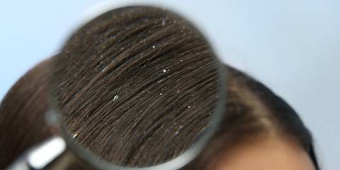 Magnifying glass being used to see women's dandruff in hair. 