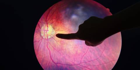an eyeball diagnosed with a diabetic problem