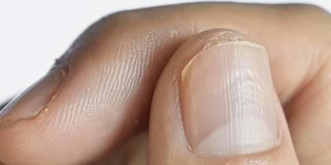 a close-up of fingernails with pitting and ridges