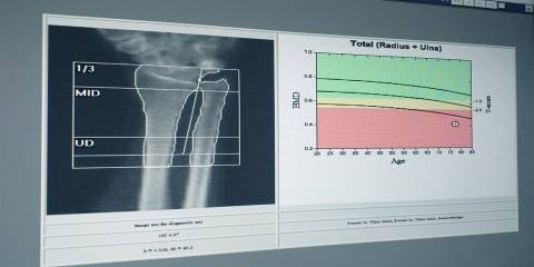 a screen showing bone mass imaging results