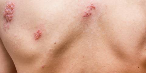 painful shingles rash on a man's back
