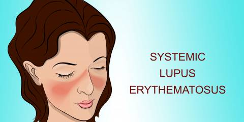 SLE (Systemic Lupus)