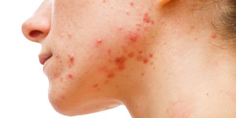 a young woman with acne on her face and jawline