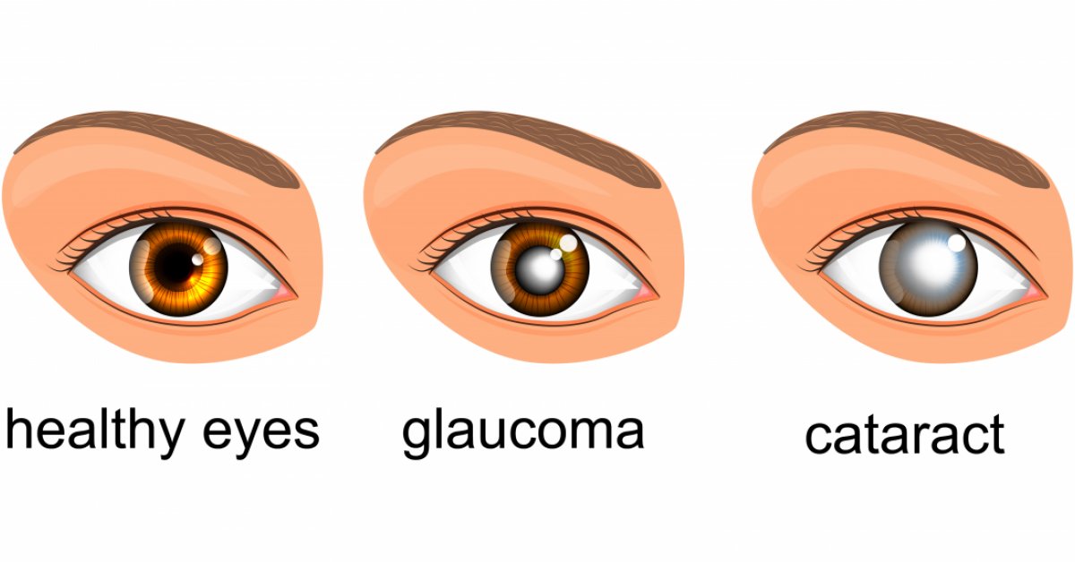 [Pilt: glaucoma.jpg?itok=eSgO5Tyj]