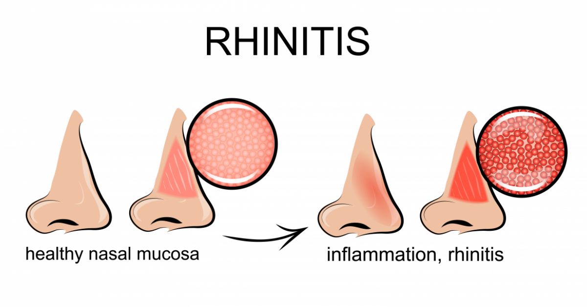 Rhinitis Taste For Life