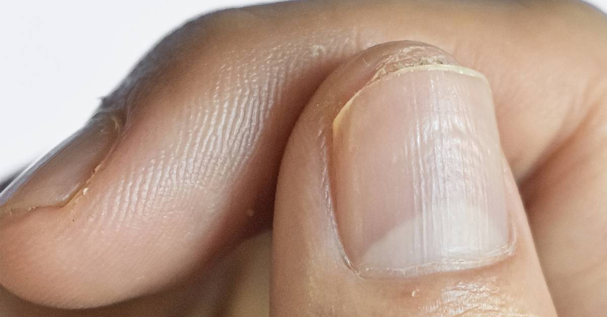 Is acetone nail polish remover bad for your nails?