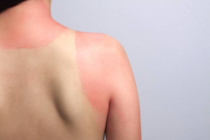 a shirtless person with a terrible sunburn