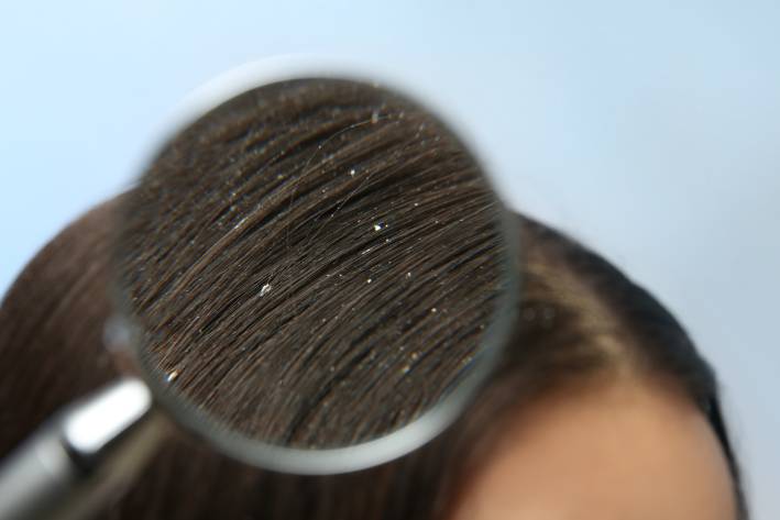 Magnifying glass being used to see women's dandruff in hair. 