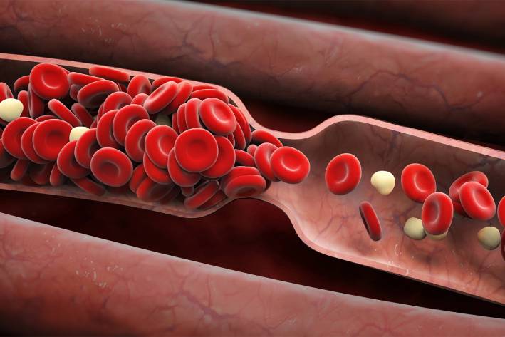 an illustration of a blood clot