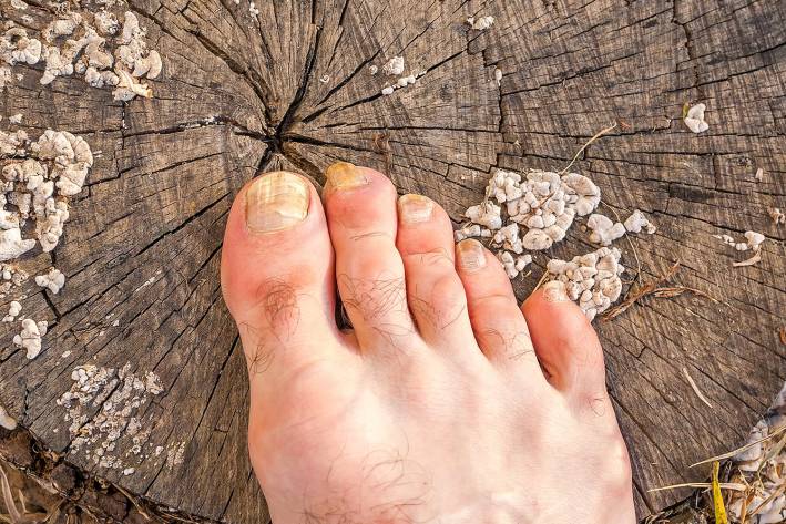 A foot suffering from a fungus infection