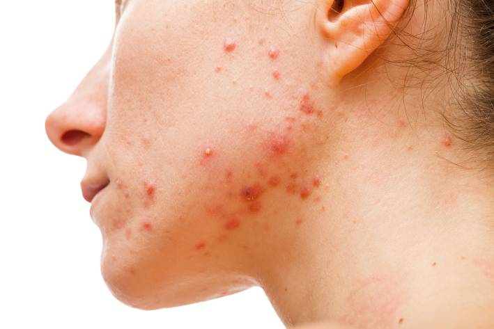 a young woman with acne on her face and jawline