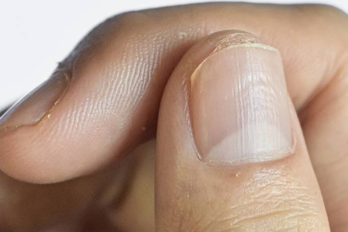 a close-up of fingernails with pitting and ridges