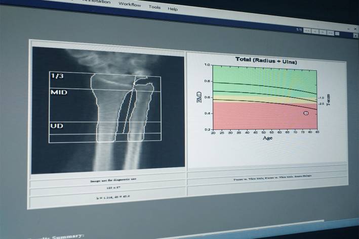 a screen showing bone mass imaging results