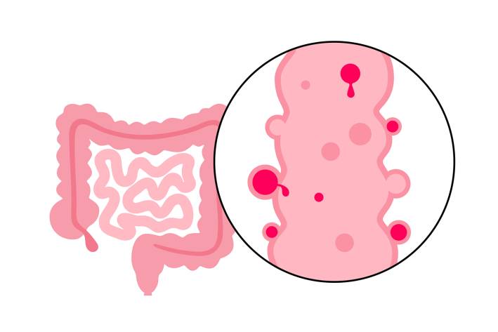 an illustration of a large intestine with inflammation and bleeding
