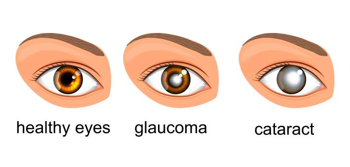 Glaucoma