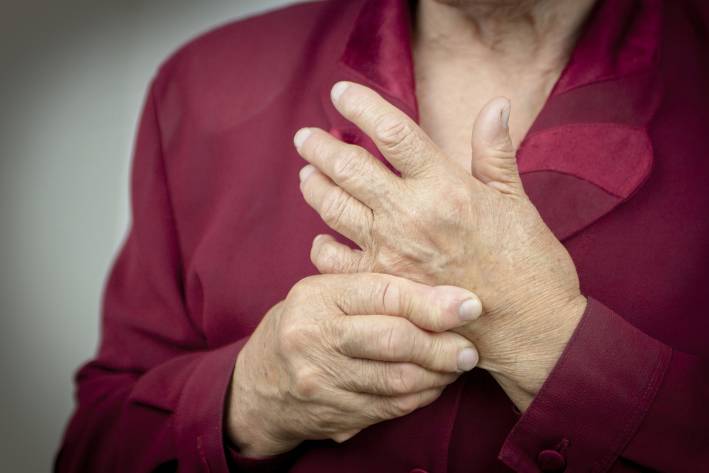 a woman with hands deformed by rheumatoid arthritis