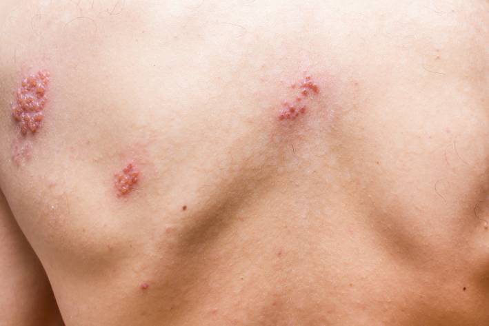 painful shingles rash on a man's back