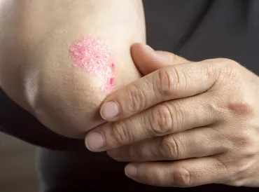 someone rubbing and scratching psoriasis on the elbow