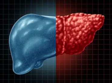 an illustration of a healthy liver compared to an unhealthy liver