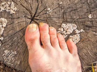 A foot suffering from a fungus infection